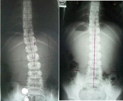 X-ray analysis
